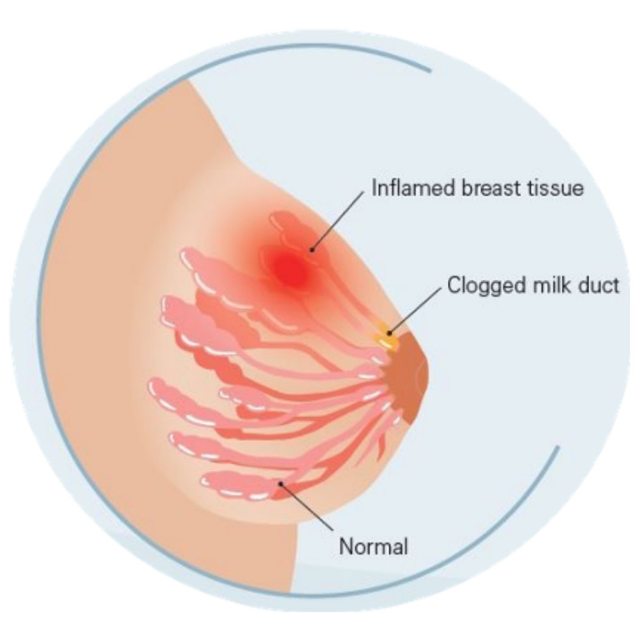 Upala dojke – mastitis