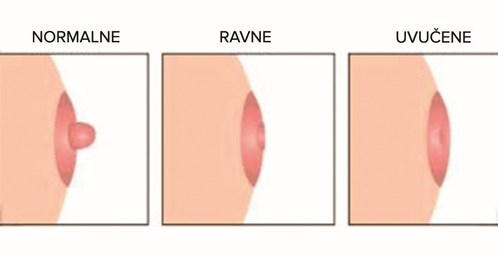 Ravne i uvučene bradavice